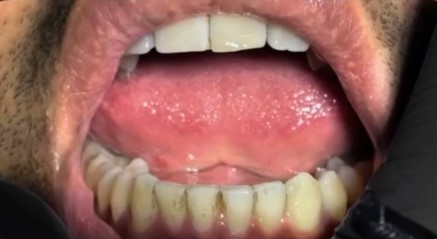 Teeth before scaling and polishing at Neodent Dental Hospital